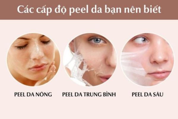 3 cấp độ peel da