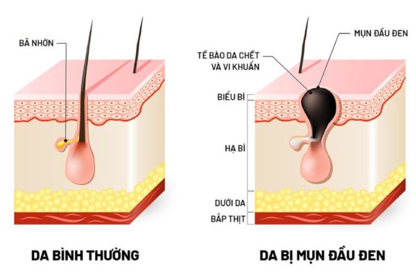 Biểu hiện và cách phòng ngừa mụn đầu đen