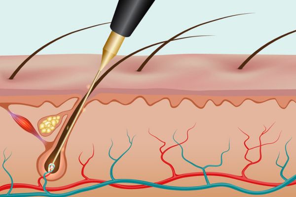 Các phương pháp triệt lông vĩnh viễn phổ biến