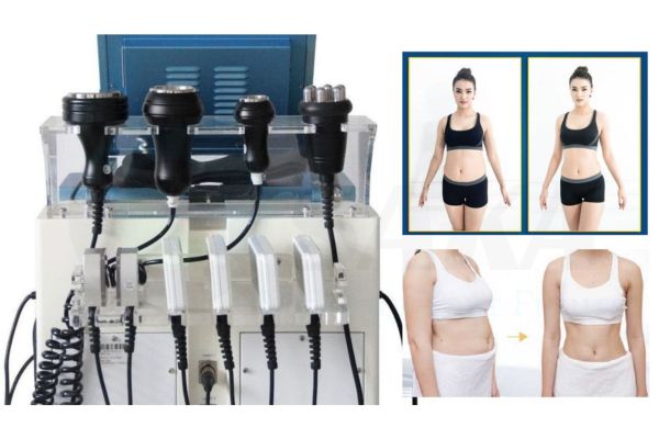 Ứng dụng của Cavitation trong ngành thẩm mỹ