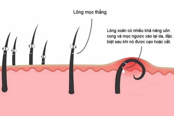 Lông mọc ngược là gì