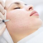 Tiêm mesotherapy là gì