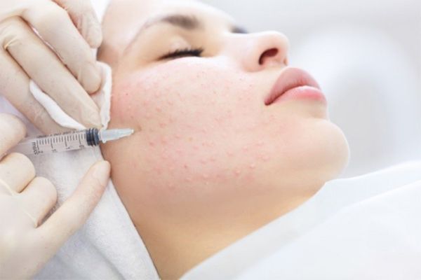 Tiêm mesotherapy là gì